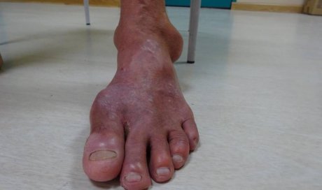 Services sur-mesure sur chaussures et appareillages orthopédiques - La Réunion - Podo Orthopédie des Mascareignes
